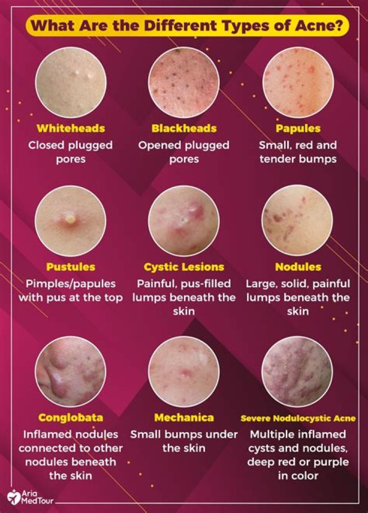 Does acetone get rid of pimples?