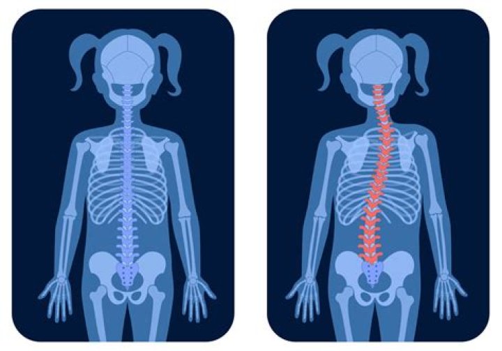 Does scoliosis affect posture? | ContextResponse.com