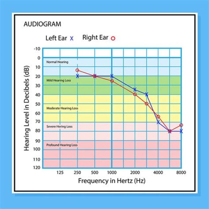 How do you read an audiometry?