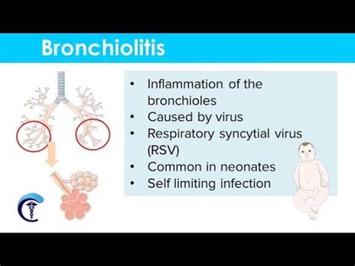 How is bronchiolitis diagnosed? | ContextResponse.com