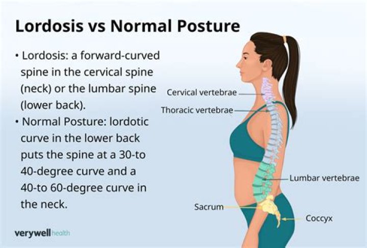 How would you Recognise lordosis?
