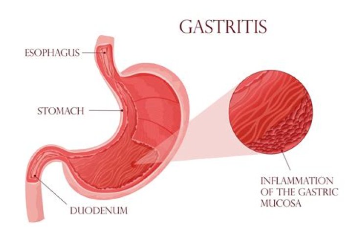 What is gastritis stomach antrum?