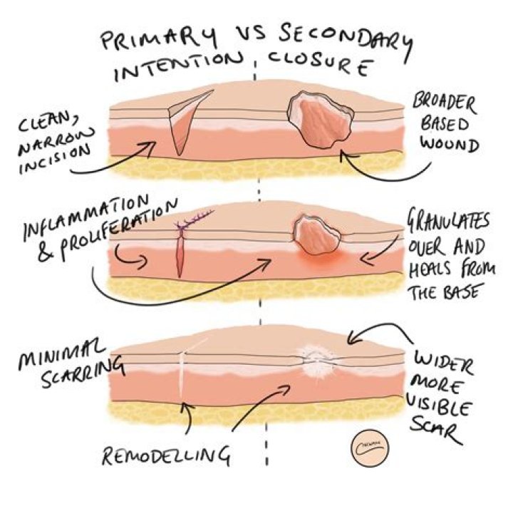 What is primary intention