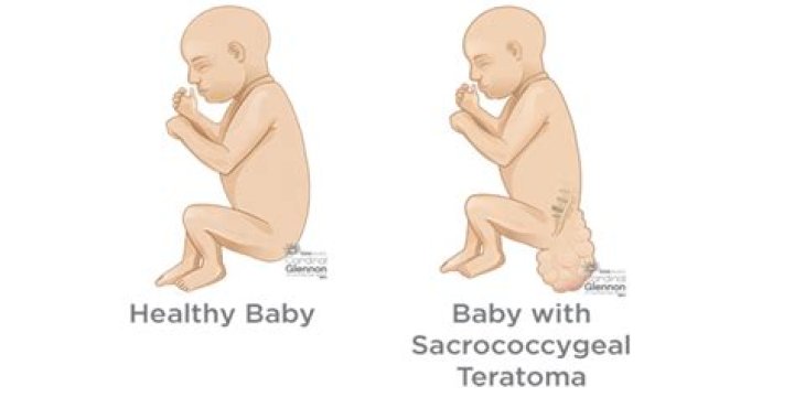 What is Sacrococcygeal disorders NEC